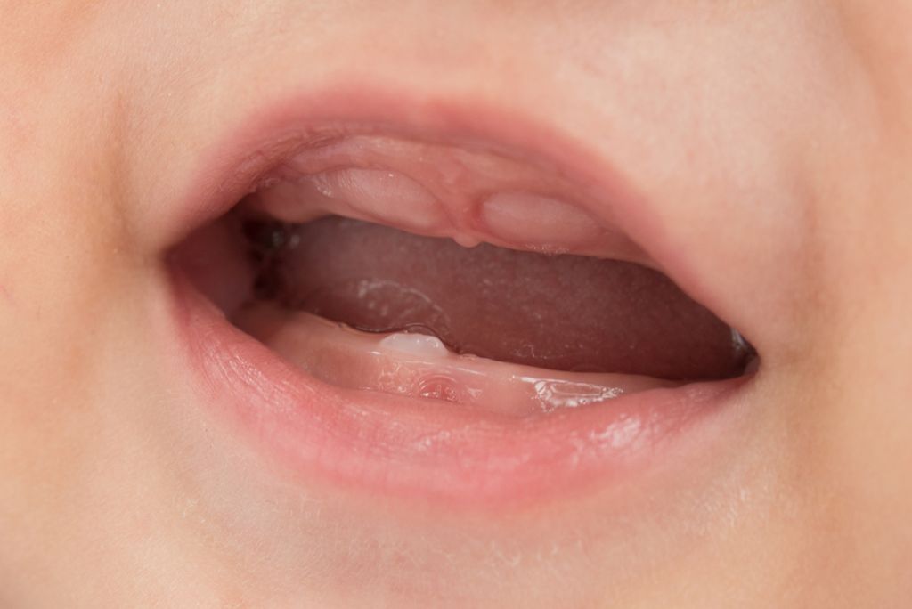 Närbild på tandkött vid tandsprickning